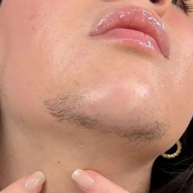 A woman's chin and jawline in the first week of use, with dark fine hair still clearly visible