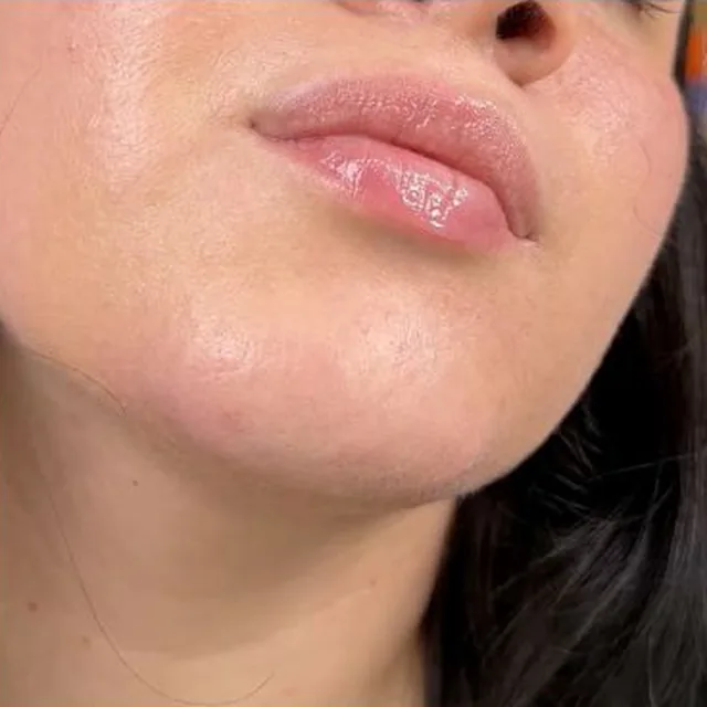 The same chin after eight weeks of use, with clear skin and no visible fine hair